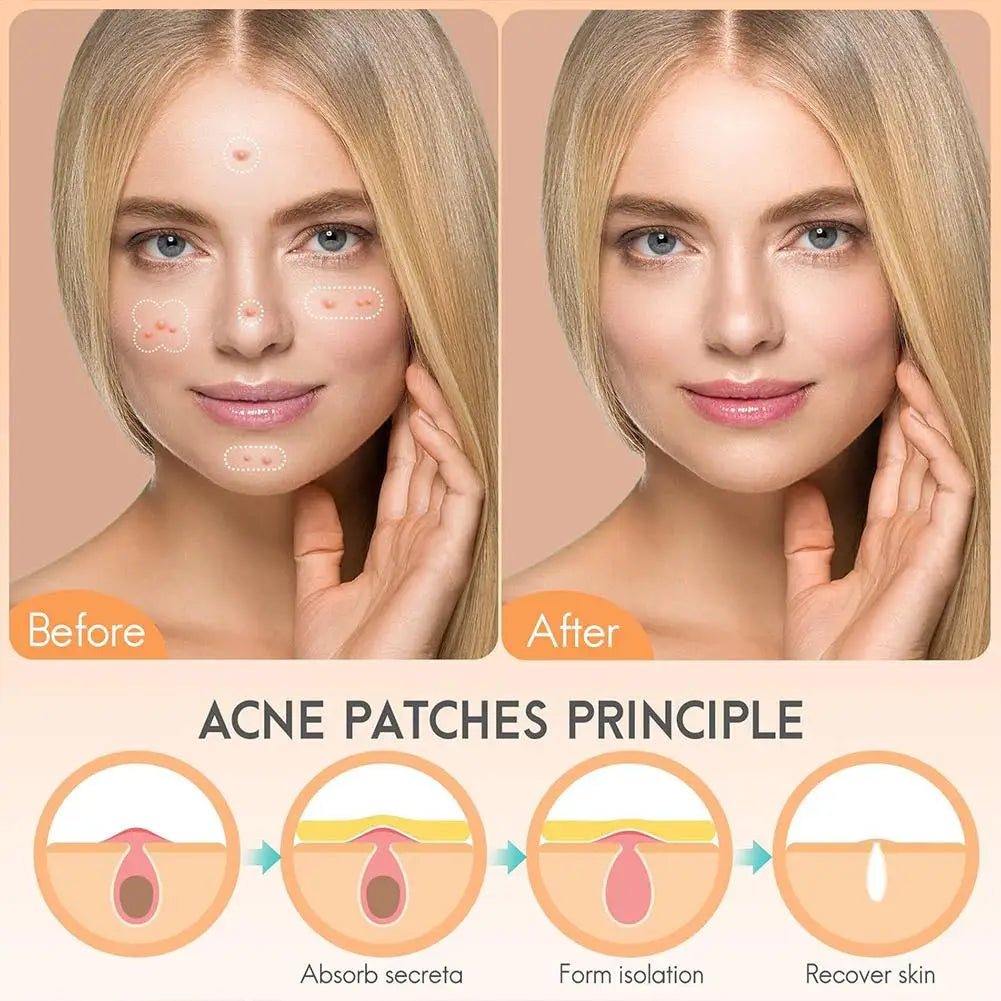 Large capacity Pimple Patches for Acne & Blemishes