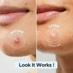 Large capacity Pimple Patches for Acne & Blemishes