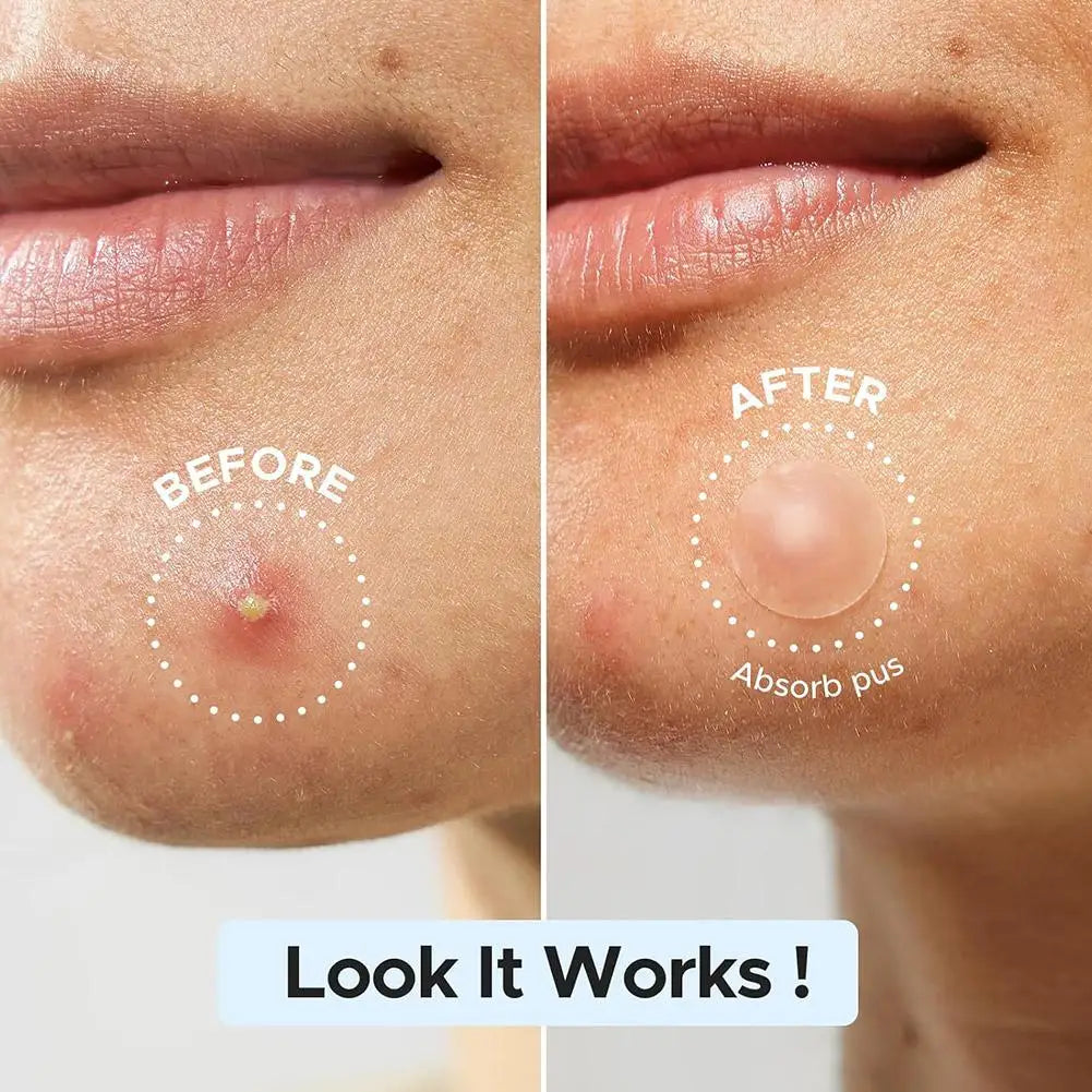 Large capacity Pimple Patches for Acne & Blemishes