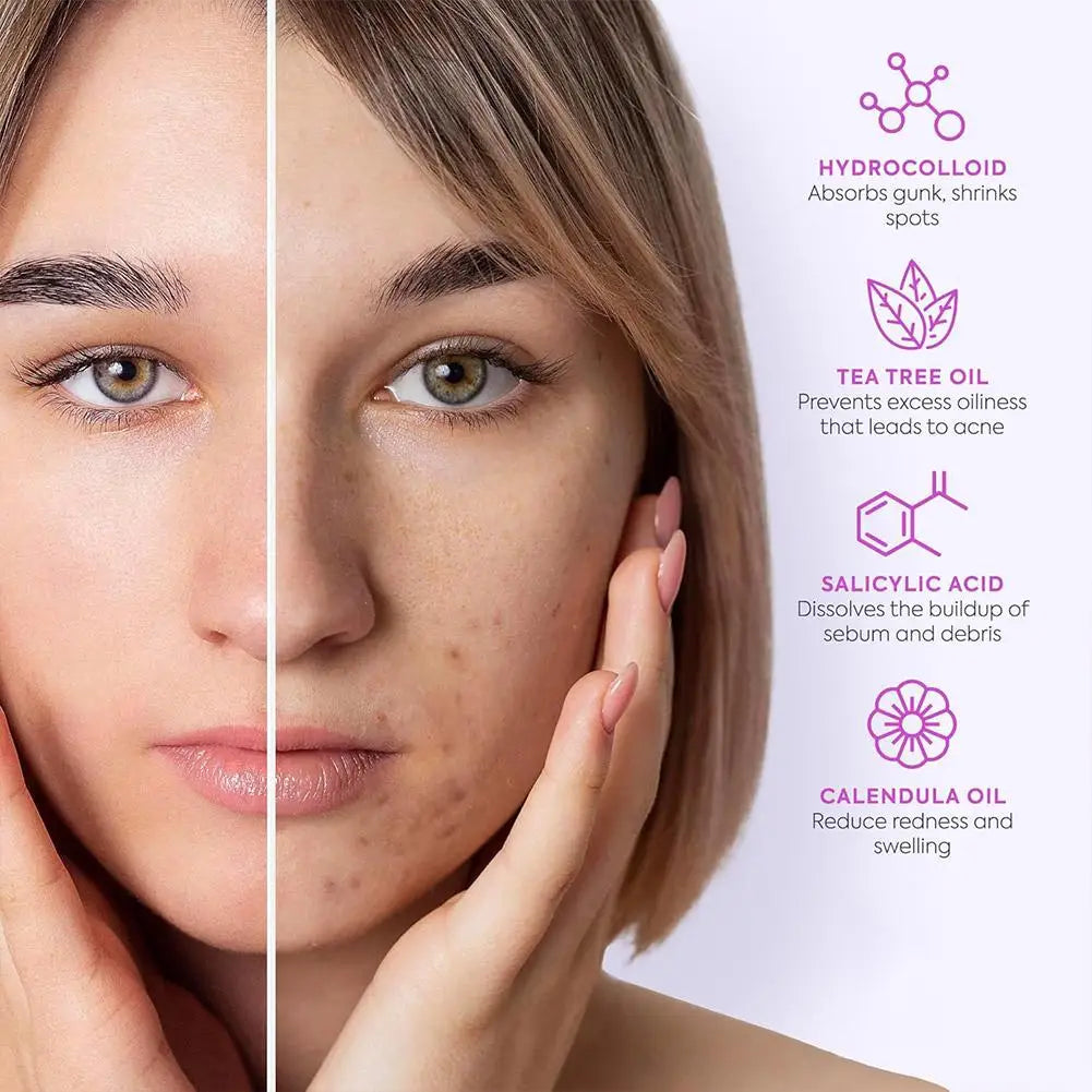 Large capacity Pimple Patches for Acne & Blemishes