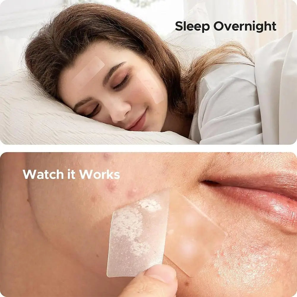 Large capacity Pimple Patches for Acne & Blemishes